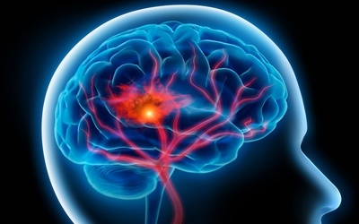 Medium strokebrain760