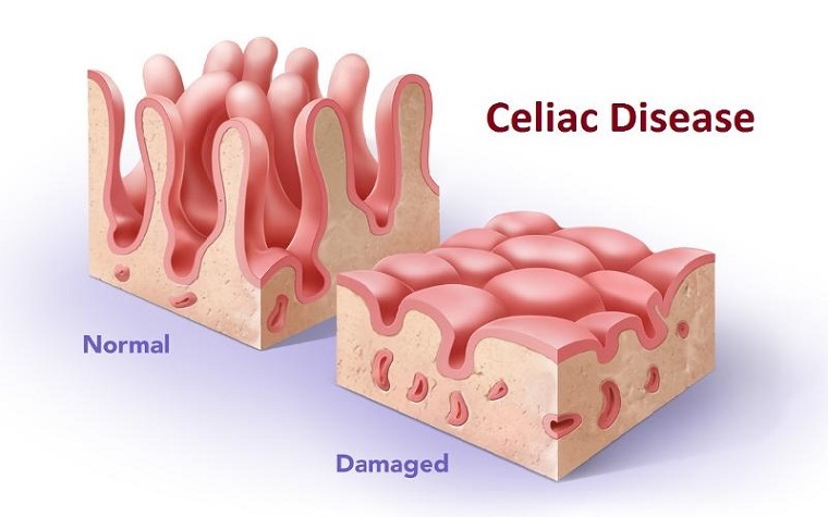 Celiac760